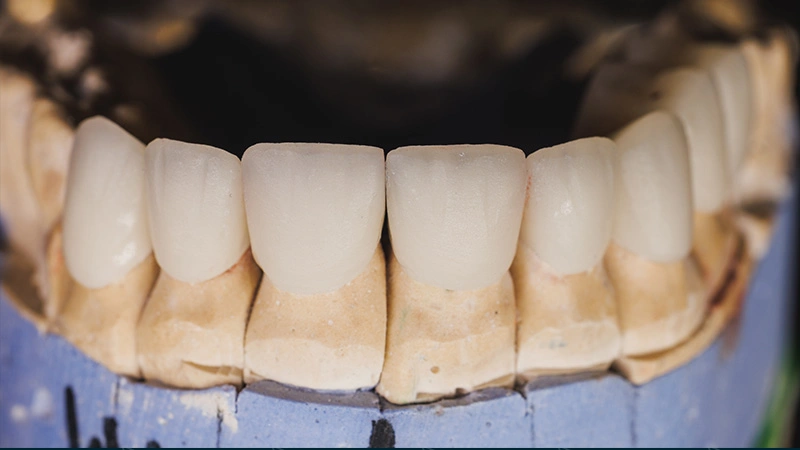 When Crowns Require More Tooth Reduction Than Veneers